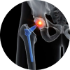 Joint Replacement Surgery-img